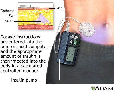 Insulin pump Insulin pump