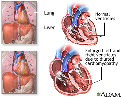 Alcoholic cardiomyopathy