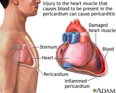 Post-MI pericarditis Post-MI pericarditis