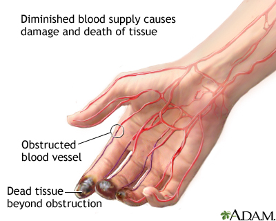 Thromboangiitis obliterans