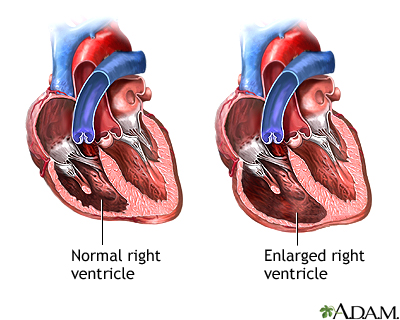 Tricuspid Regurgitation Tricuspid Regurgitation
