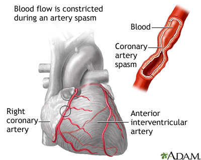 Coronary artery spasm Coronary artery spasm