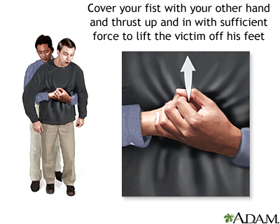 Heimlich maneuver on an adult Heimlich maneuver on an adult