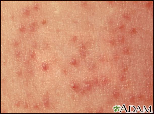 Keratosis pilaris - close-up Keratosis pilaris - close-up