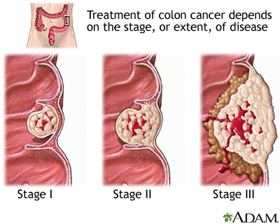 Stages of cancer Stages of cancer