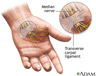 Compression of the median nerve Compression of the median nerve