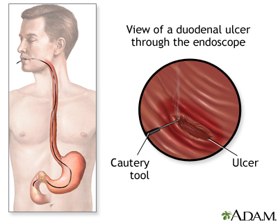 Gastroscopy procedure Gastroscopy procedure