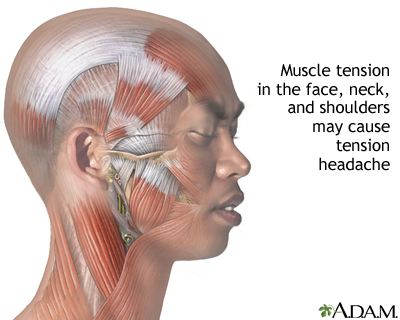 Tension-type headache Tension-type headache