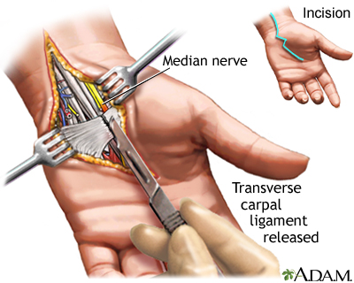 Carpal tunnel surgical procedure Carpal tunnel surgical procedure