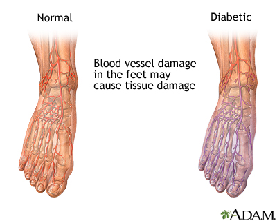 Diabetic blood circulation in foot Diabetic blood circulation in foot