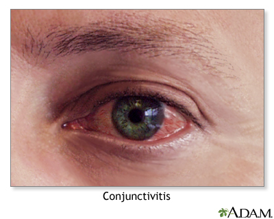 Conjunctivitis Conjunctivitis