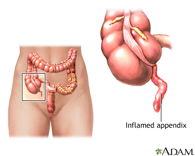 Appendicitis Appendicitis