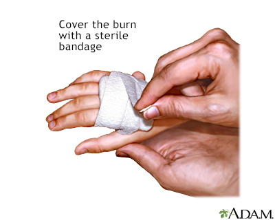 Minor burn treatment - apply bandage Minor burn treatment - apply bandage