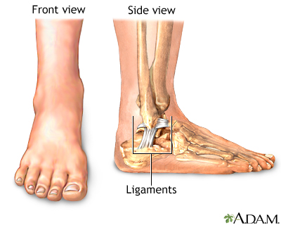 Ankle sprain - Series Ankle sprain - Series