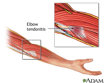 Tendonitis Tendonitis