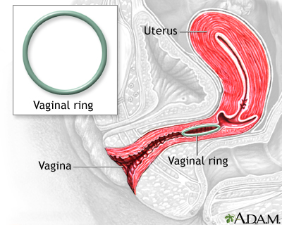 Vaginal ring Vaginal ring