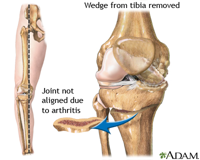 Tibial osteotomy