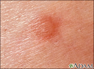 Flea bite - close-up Flea bite - close-up