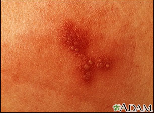 Herpes simplex - close-up Herpes simplex - close-up