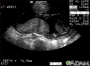 Ultrasound, normal placenta - Braxton Hicks Ultrasound, normal placenta - Braxton Hicks