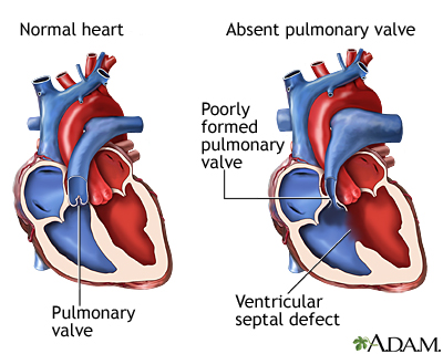 Absent pulmonary valve Absent pulmonary valve