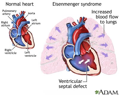 Eisenmenger syndrome (or complex)