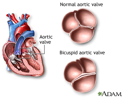 Bicuspid aortic valve Bicuspid aortic valve