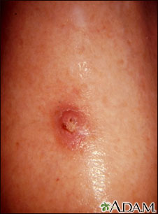 Keratoacanthoma Keratoacanthoma