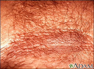 Acanthosis nigricans - close-up Acanthosis nigricans - close-up