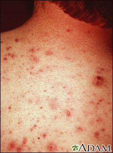 Acne - vulgaris on the back Acne - vulgaris on the back