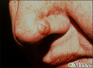 Skin cancer, basal cell carcinoma - nose Skin cancer, basal cell carcinoma - nose