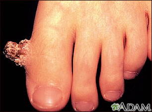 Wart (verruca) with a cutaneous horn on the toe Wart (verruca) with a cutaneous horn on the toe