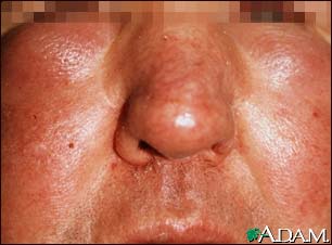 Edema - central on the face