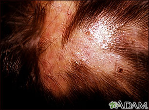 Folliculitis - decalvans on the scalp Folliculitis - decalvans on the scalp