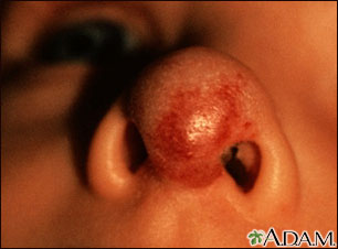 Hemangioma on the face (nose) Hemangioma on the face (nose)
