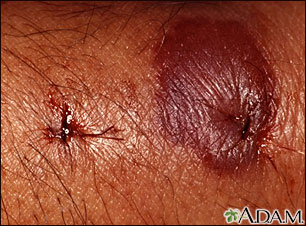 Insect bite reaction - close-up Insect bite reaction - close-up