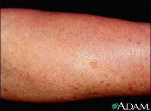 Mastocytosis - diffuse cutaneous Mastocytosis - diffuse cutaneous