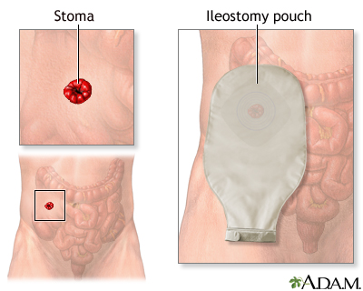Ileostomy - stoma and pouch Ileostomy - stoma and pouch