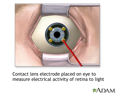 Contact lens electrode on eye Contact lens electrode on eye