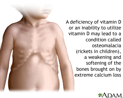 Vitamin D deficit Vitamin D deficit