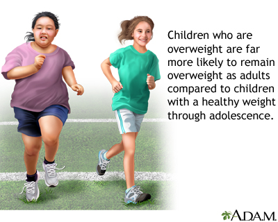 Childhood obesity Childhood obesity