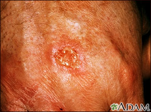 Skin cancer, squamous cell - close-up Skin cancer, squamous cell - close-up