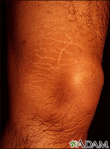 Striae on the leg Striae on the leg