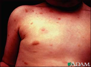 Urticaria pigmentosa on the chest Urticaria pigmentosa on the chest