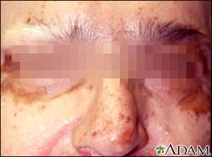 Vitiligo on the face Vitiligo on the face