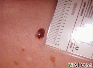 Skin cancer - close-up of level III melanoma Skin cancer - close-up of level III melanoma