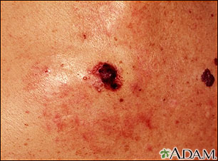 Skin cancer - close-up of level IV melanoma Skin cancer - close-up of level IV melanoma