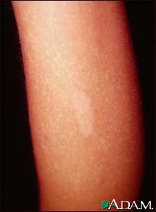 Tuberous sclerosis - hypopigmented macule Tuberous sclerosis - hypopigmented macule