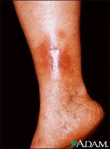 Dermatitis - stasis on the leg Dermatitis - stasis on the leg