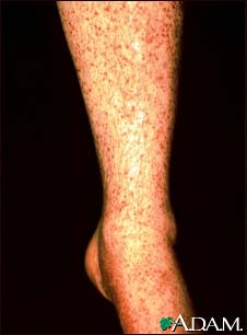 Vasculitis Vasculitis